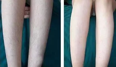 冰点脱毛,春季整形,长春好的整形医院