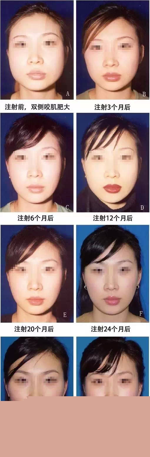 注射,瘦脸针,对比图,长春好的整形医院