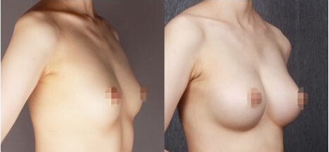 隆胸假体,水滴形,对比图,长春好的整形医院