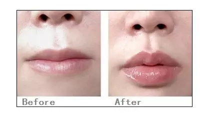 丰唇,对比图,长春好的整形医院