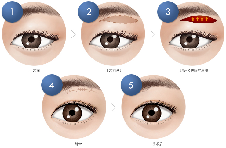 切眉术,长春好的整形医院
