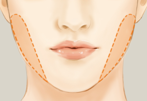 颊脂肪垫,摘除,瘦脸术,长春好的整形医院