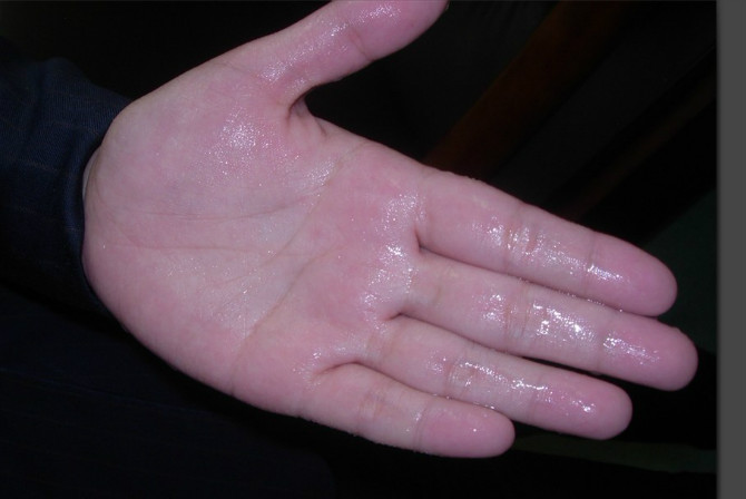 多汗症,肉毒素,长春好的整形医院