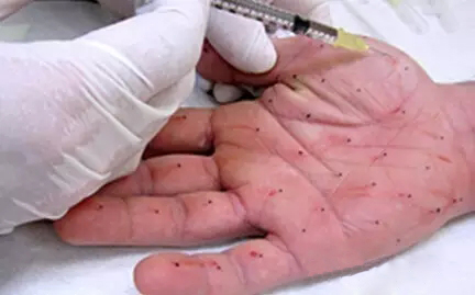 多汗症,肉毒素,长春好的整形医院