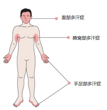 多汗症,肉毒素,长春好的整形医院