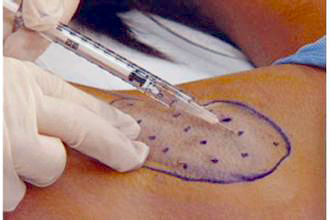 多汗症,肉毒素,长春好的整形医院