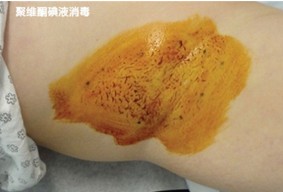 多汗症,肉毒素,长春好的整形医院