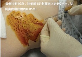 多汗症,肉毒素,长春好的整形医院