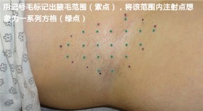 多汗症,肉毒素,长春好的整形医院