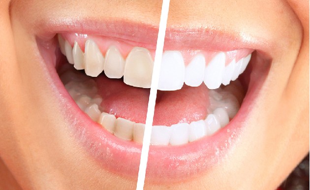 德国,VITA,瓷贴面,长春好的整形医院