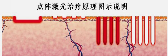 点阵激光,长春好的整形医院