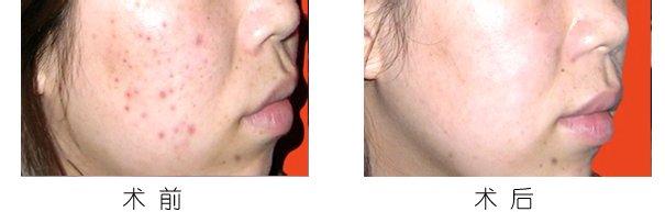 青春痘,激光祛痘,对比图,长春好的整形医院