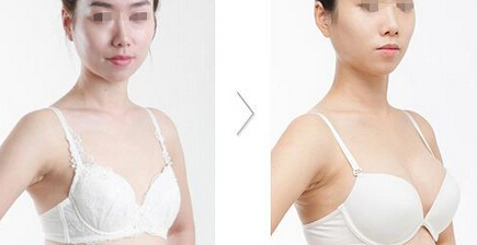 自体脂肪丰胸的效果是长久的吗