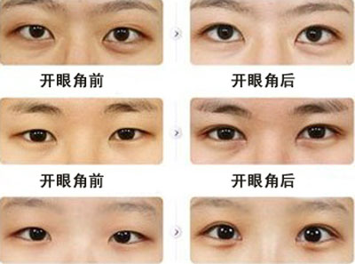 开眼角前后对比图