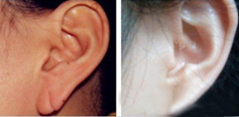 附耳切除的手术过程