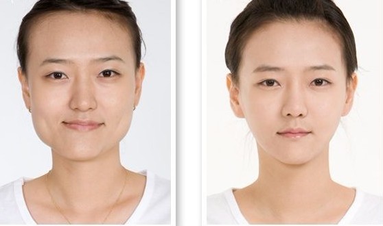 下颌角整形,对比图,长春好的整形医院