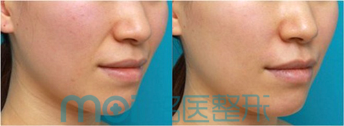 玻尿酸,除皱,对比图,长春好的整形医院