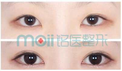开眼角,双眼皮,对比图,长春好的整形医院