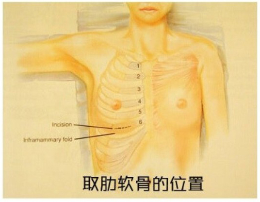 自体,肋软骨,隆鼻,过程,长春好的整形医院