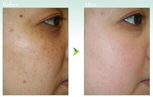 哪些因素影响去除黄褐斑的价格