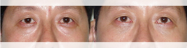 男性,眼袋修复,对比图,长春好的整形医院