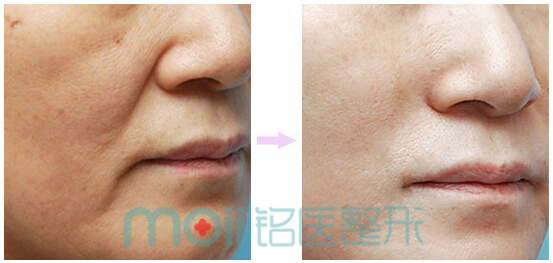 鼻唇沟,对比图,长春好的整形医院