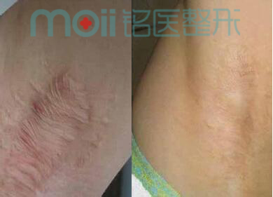 激光祛疤,对比图,长春好的整形医院