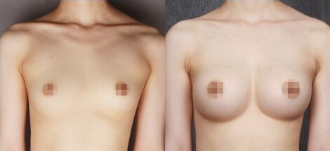 隆胸假体,圆形,对比图,长春好的整形医院