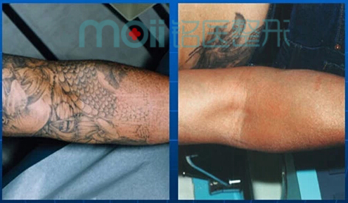 文身,纹身,对比图,长春好的整形医院