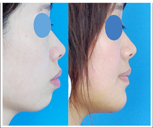 没有疤痕综合改脸整形