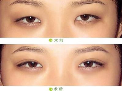 北京艺星双眼皮效果