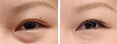 去眼袋前后对比图