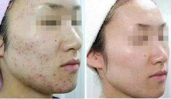 长春激光祛痘,去脸上痘痕,铭医激光祛痘