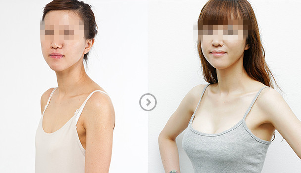 长春假体隆胸,隆胸哪里好,假体隆胸价格