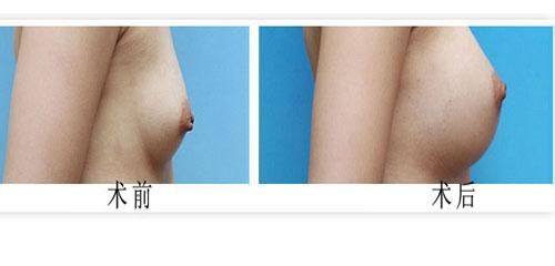 长春假体隆胸,假体隆胸价格,隆胸哪里好