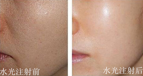 长春水光针,水光针补水,水光针哪里好