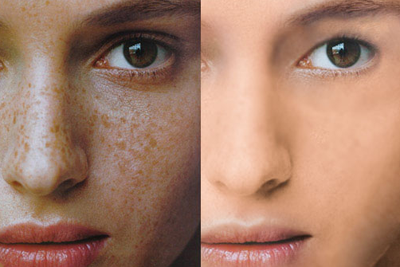 长春激光祛斑,祛斑哪里好,铭医激光祛斑