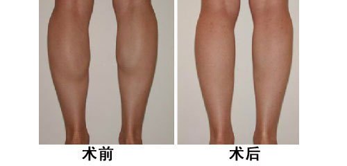 长春瘦小腿,肉毒素瘦小腿