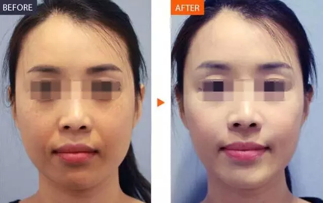 长春水光针,水光针哪里好,铭医水光针