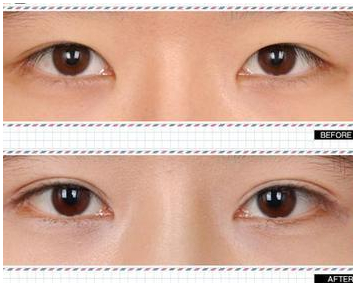 长春双眼皮,双眼皮哪里好,双眼皮多少钱