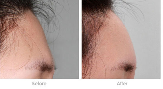 长春丰额头,玻尿酸丰额头,丰额头哪里好