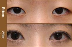 长春开眼角,开眼角多少钱,开眼角对比图