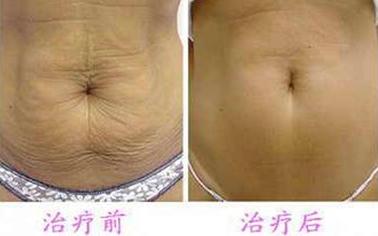 长春去妊娠纹,妊娠纹怎么去,激光去妊娠纹