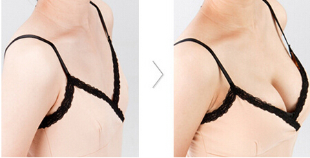 长春假体隆胸,隆胸哪里好,假体隆胸价格