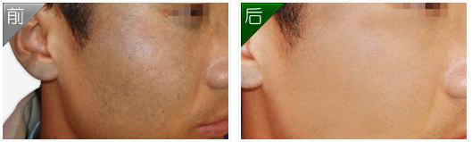 长春去黑痣,去黑痣多少钱,激光去黑痣