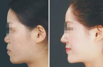 长春玻尿酸,玻尿酸隆鼻,隆鼻哪里好