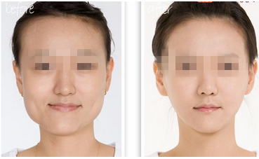 长春瘦咬肌,瘦咬肌哪里好,长春瘦脸