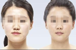 长春去皱价格.去皱哪里好,保妥适去皱