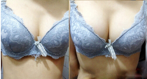 长春假体隆胸,隆胸哪里好,隆胸去哪里