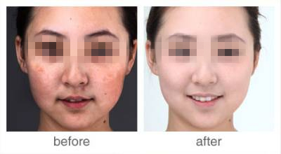 长春激光祛斑,激光祛斑价格,祛斑哪里好